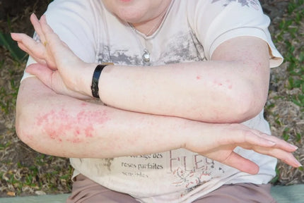 Calming Down Eczema, Psoriasis and Dermatitis