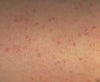 Magnesium Cream Relieves Keratosis - 'Chicken Skin'