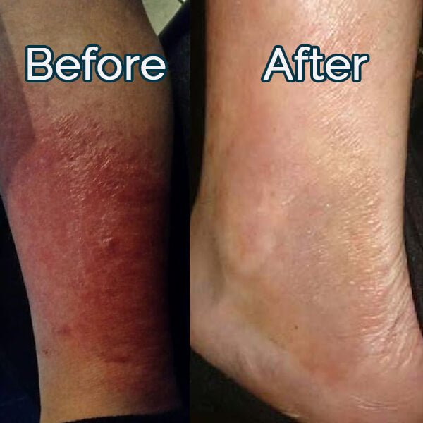 Dion's Rash Recovery with Elektra Magnesium Cream - Elektra Magnesium