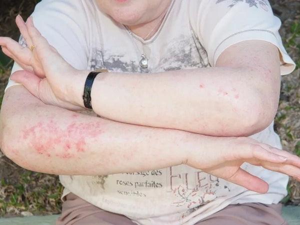 Calming Down Eczema, Psoriasis and Dermatitis - Elektra Magnesium