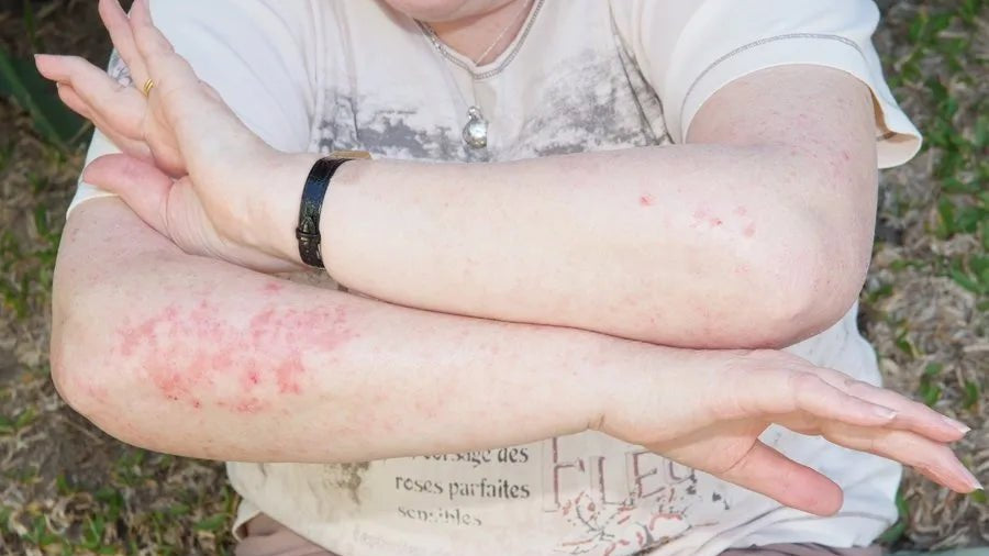 Calming Down Eczema, Psoriasis and Dermatitis - Elektra Magnesium