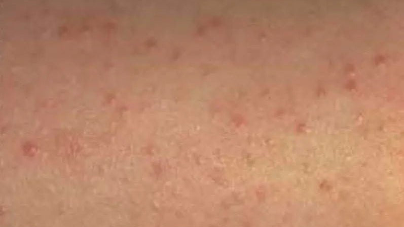 Magnesium Cream Relieves Keratosis - 'Chicken Skin' - Elektra Magnesium