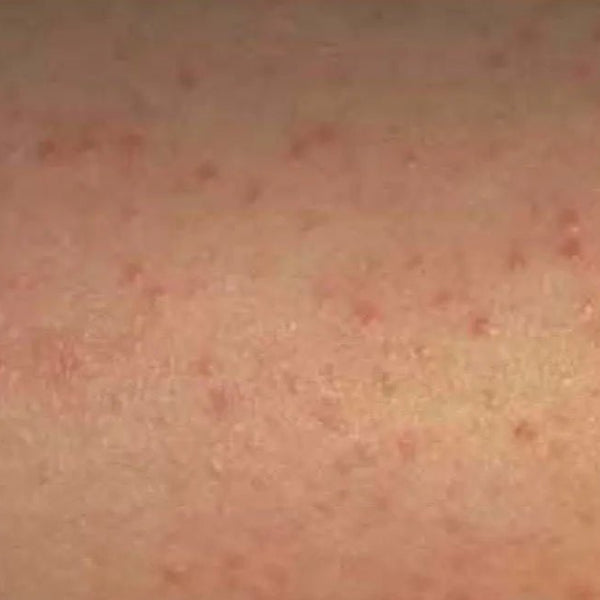 Magnesium Cream Relieves Keratosis - 'Chicken Skin' - Elektra Magnesium