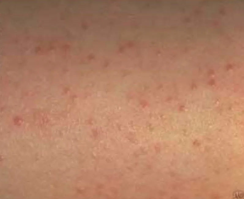 Magnesium Cream Relieves Keratosis - 'Chicken Skin'