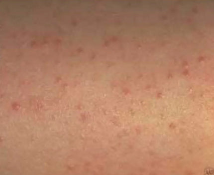 Magnesium Cream Relieves Keratosis - 'Chicken Skin'